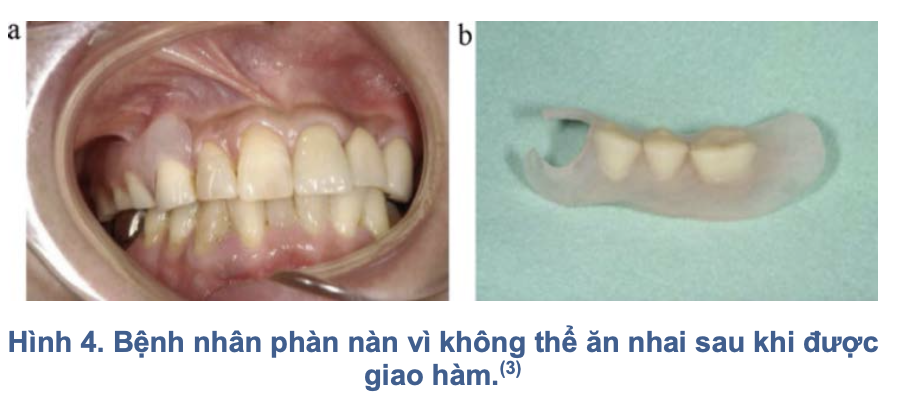Hàm nhựa dẻo trong phục hình tháo lắp: Đặc tính, chỉ định và biến chứng lâm sàng